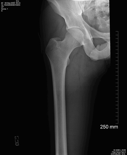 Bone density xray